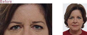 Before BOTOX Example
