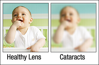 Healthy Lens versus Cataracts