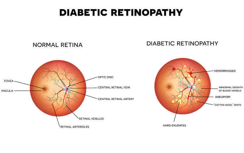Chart Showing What Diabetic Retinopathy Looks Like in The Eye