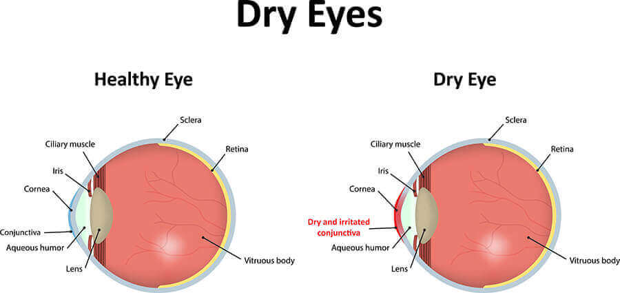 Chart Showing the Difference Between a Healthy Eye and One that Has Dry Eyes