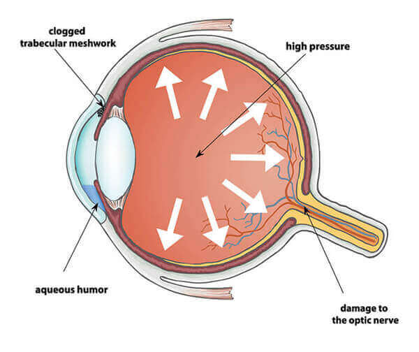 Chart Showing What Glaucoma Does Inside the Eye