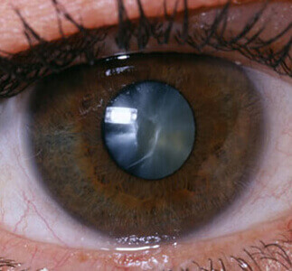 Close up of an eye with Cataracts