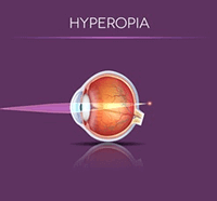 Hyperopia in the Eye