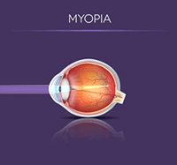 Myopia in the Eye