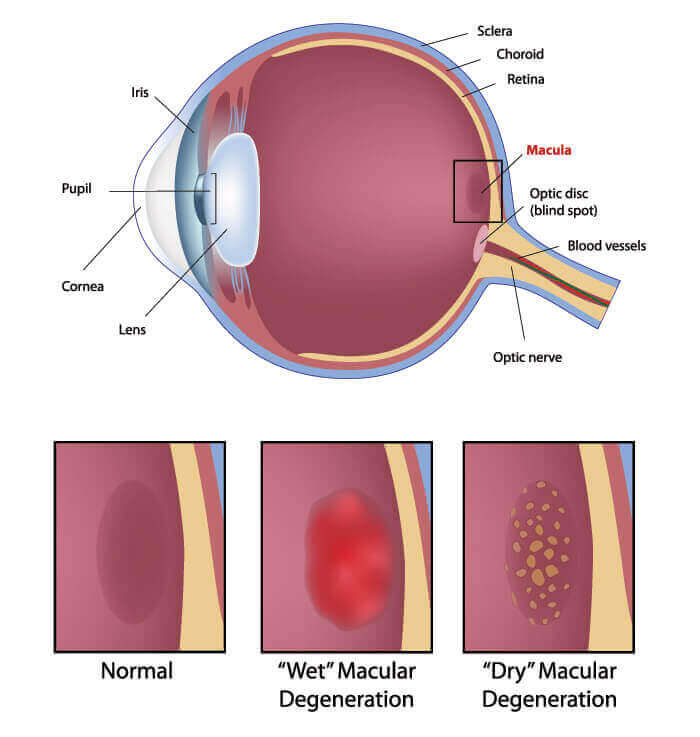 Diagram Showing What Macular Degeneration Looks Like in The Eye