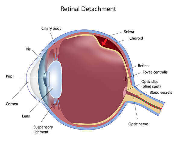 Diagram Showing What it Look Like to Have a Retinal Detachment