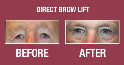 Direct Brow Lift Before and After