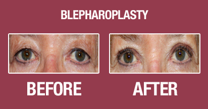 Blepharoplasty Before & After