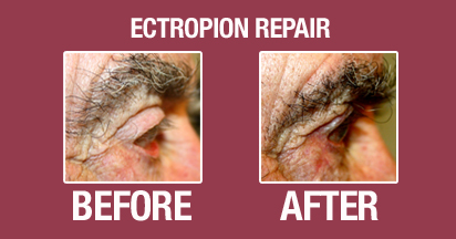 Ectropion Before and After