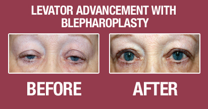 Blepharoplasty Before & After