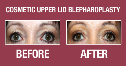 Cosmetic upper lid blepharoplasty before and after