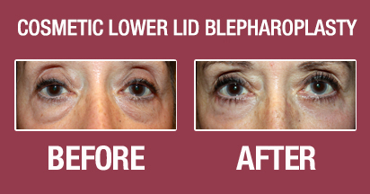 Cosmetic Lower Lid Blepharoplasty Before & After