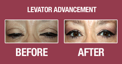 Levator Advancement Before and After