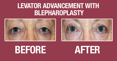 Blepharoplasty Before & After