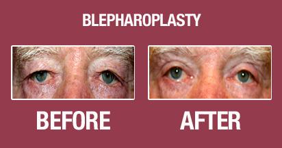 Blepharoplasty Before & After