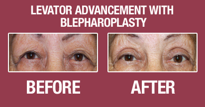 Blepharoplasty Before & After