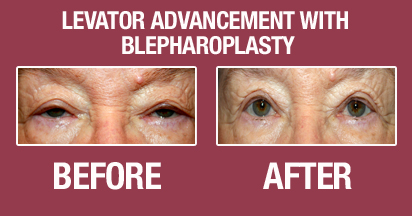 Blepharoplasty Before & After