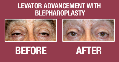 Blepharoplasty Before & After