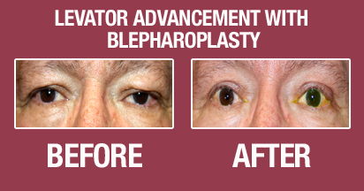 Blepharoplasty Before & After