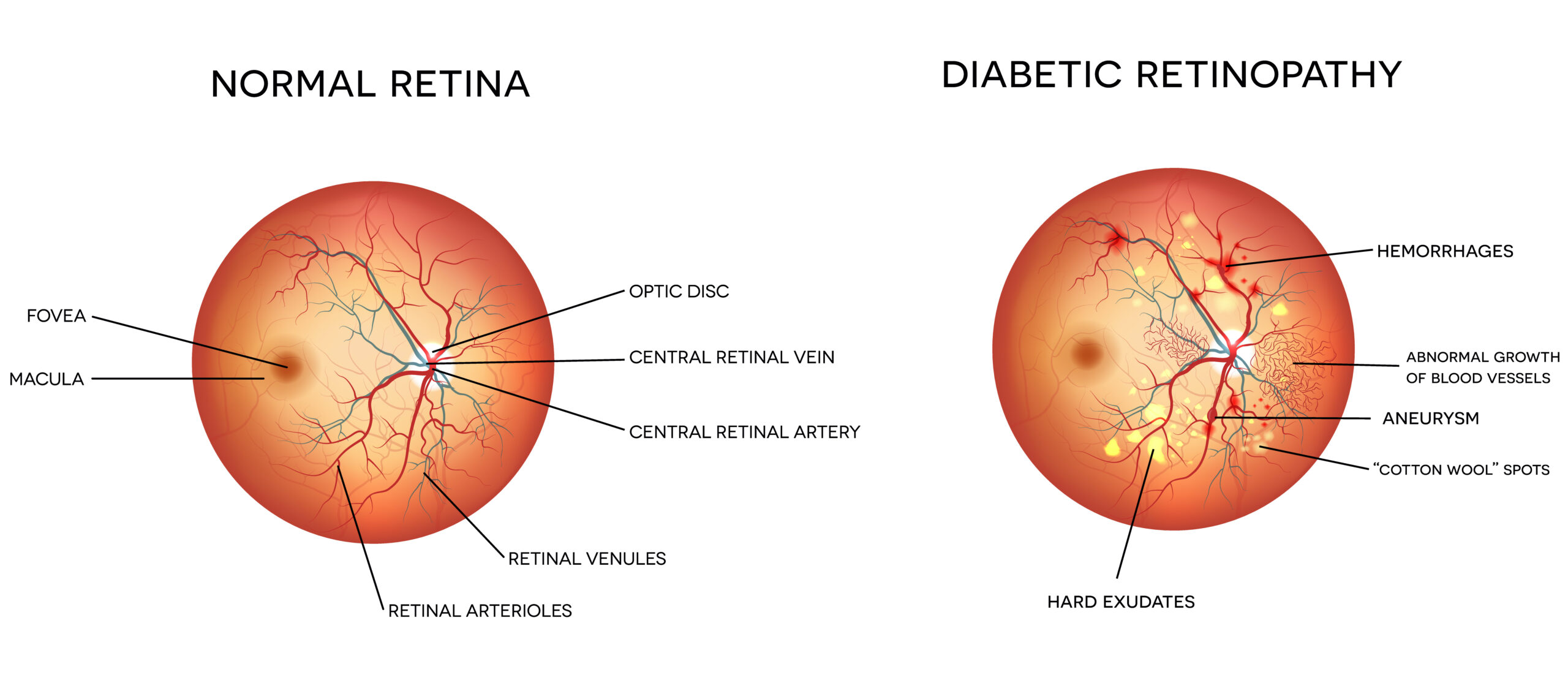 Diagram of diabetic retinopathy and normal eye retina.