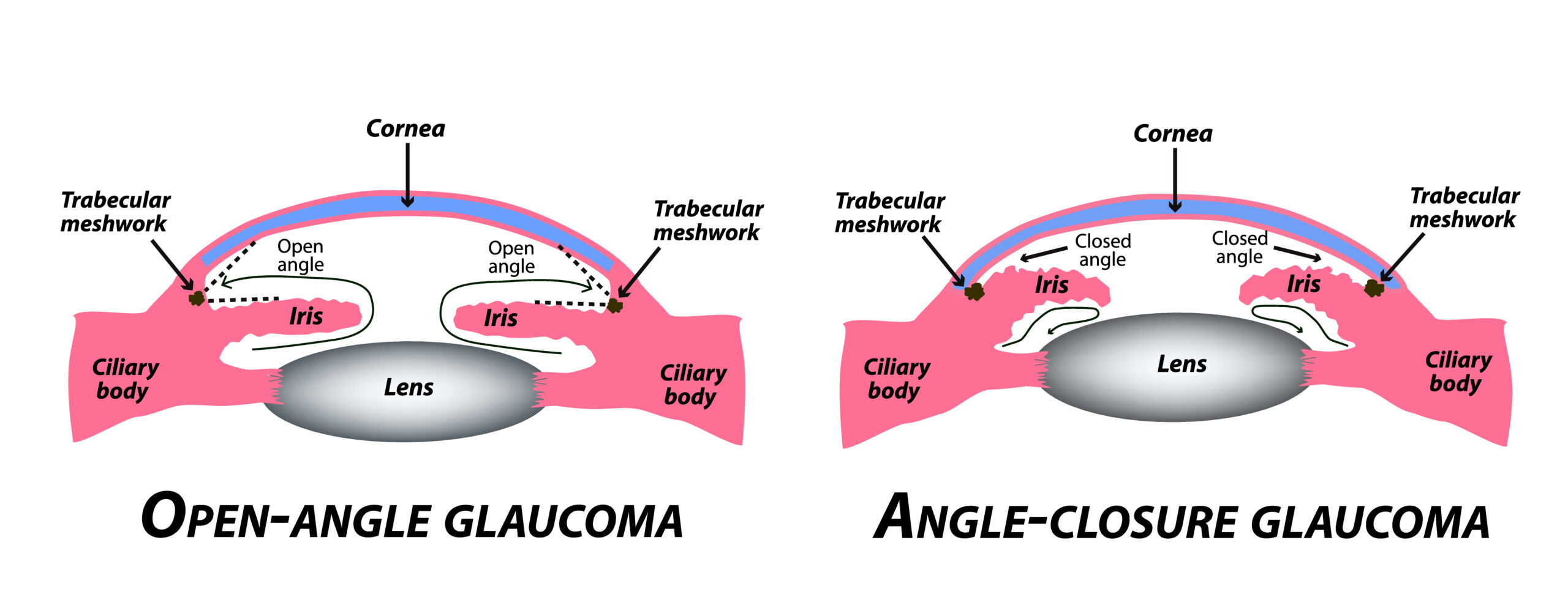 Types of glaucoma. Open-angle and angle-closure glaucoma. The anatomical structure of the eye. Infographics. illustration on isolated background.