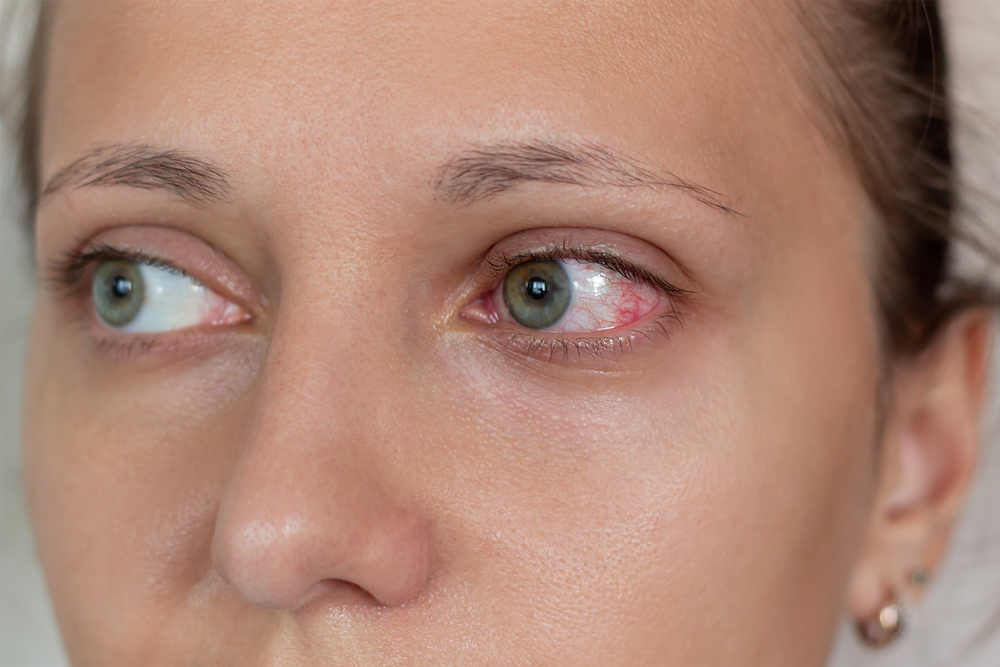 Close up of a woman with bloodshot eyes